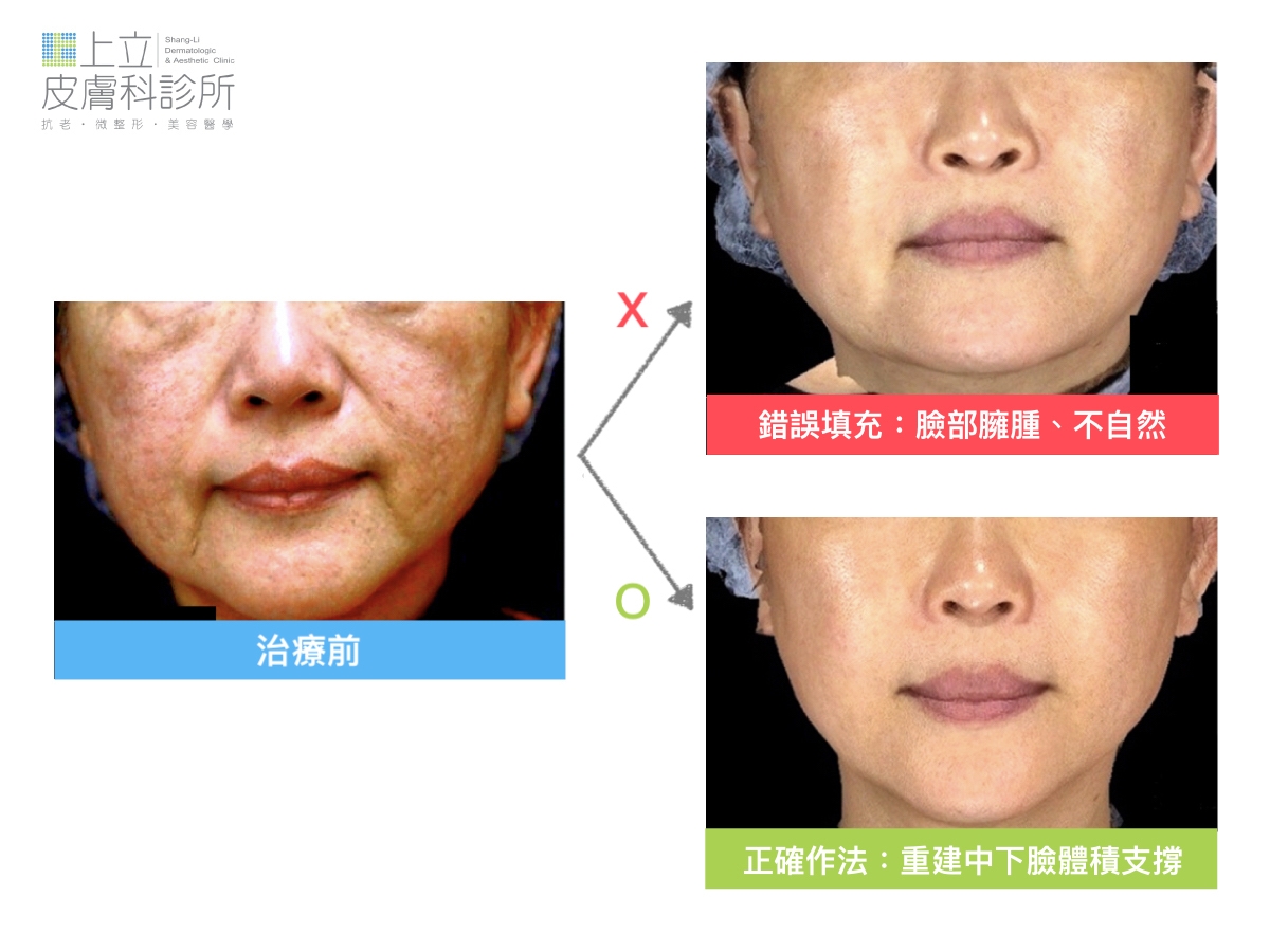 臉部的法令紋、淚溝等紋路好像都消失了，但造成嘴邊肉變大、臉型異常臃腫
