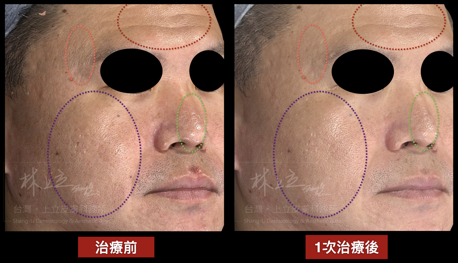 Genius精靈電波，根據皮膚上的不同問題，靈活調整治療深度，改善細紋、毛孔、滾動型凹疤