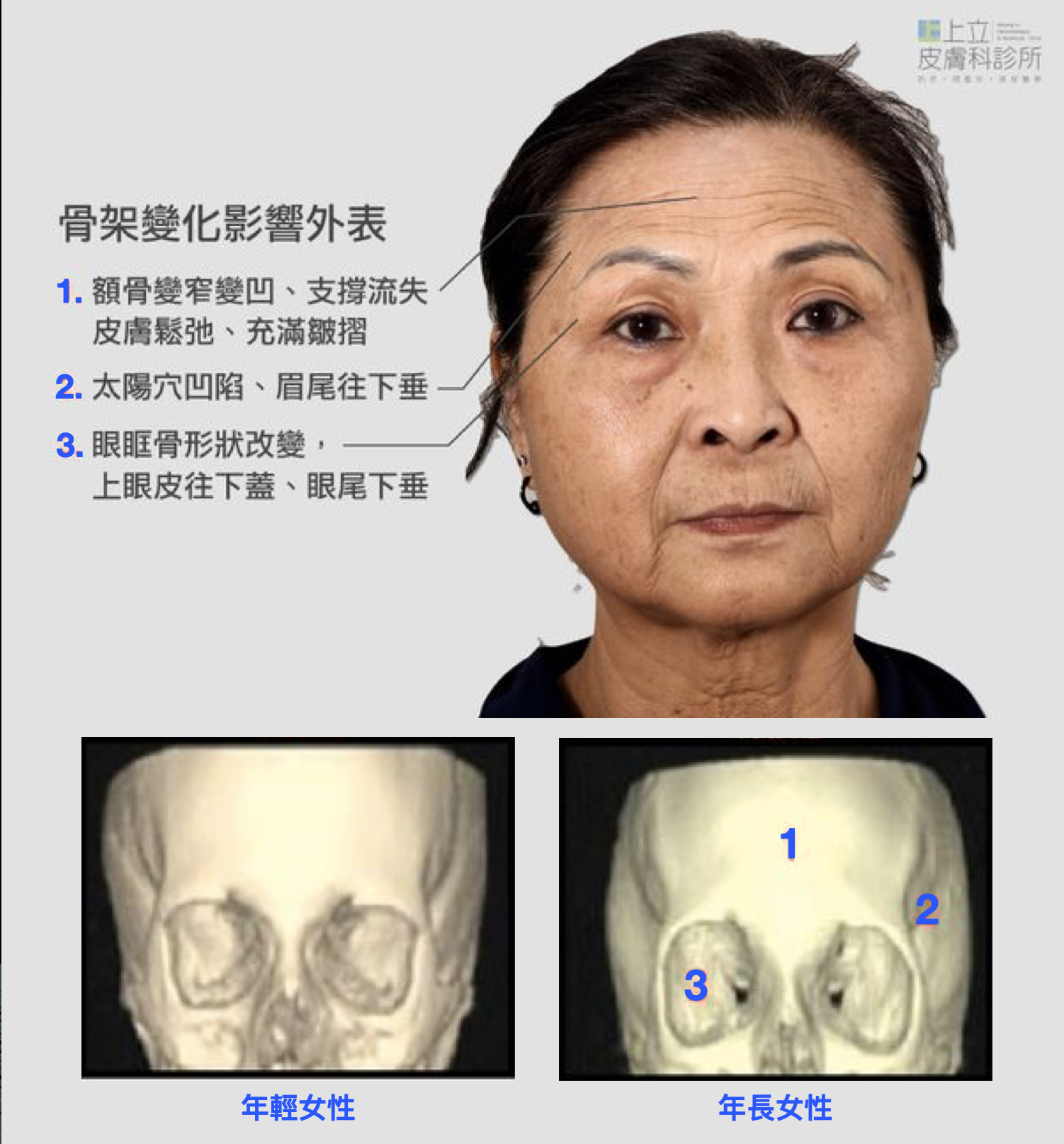 ELLANS&Eacute;洢蓮絲對於額頭微整形的優勢，不僅可以將骨架和深層脂肪流失的體積重建「支撐」回來，還能增加皮膚的彈性