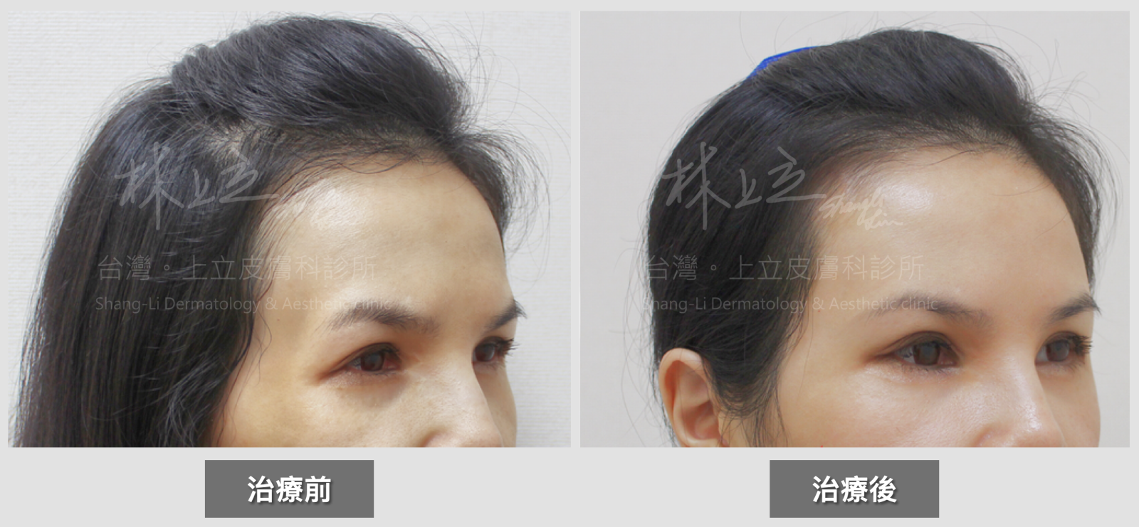 注射ELLANS&Eacute;洢蓮絲之後，額頭的圓弧度、平滑度、膚質細膩度提升