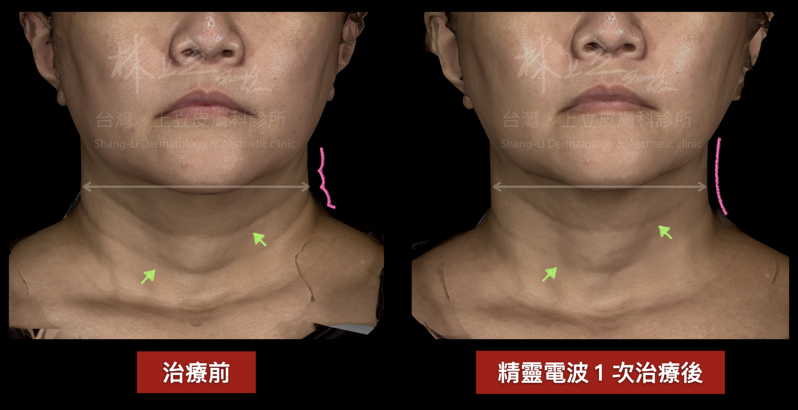 使用Genius精靈電波，脖子和臉型寬度都往內收緊，看起來更加年輕