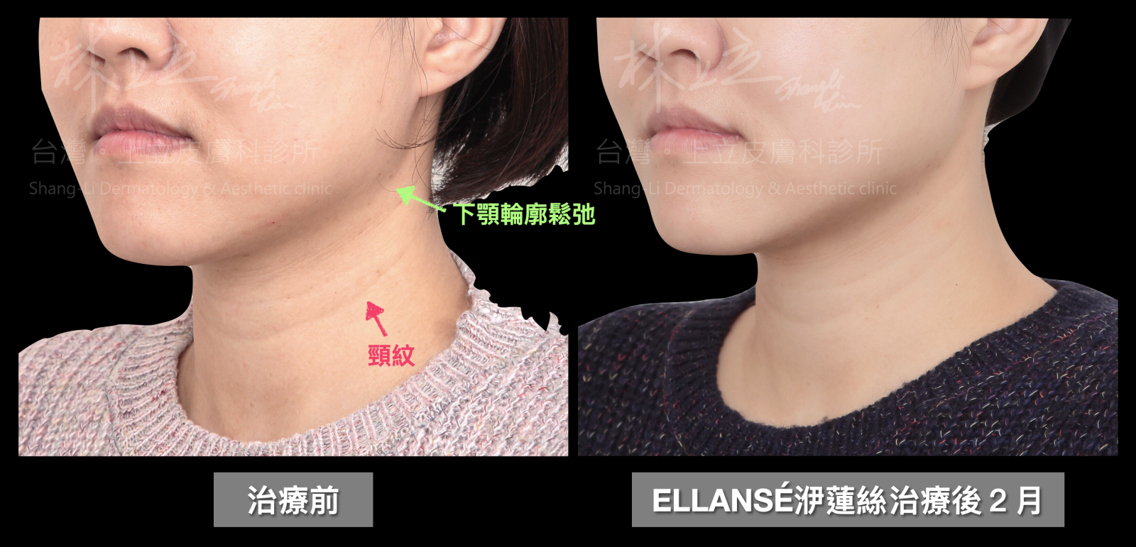 ELLANS&Eacute;洢蓮絲來重建支撐，讓下顎輪廓恢復鮮明、俐落線條