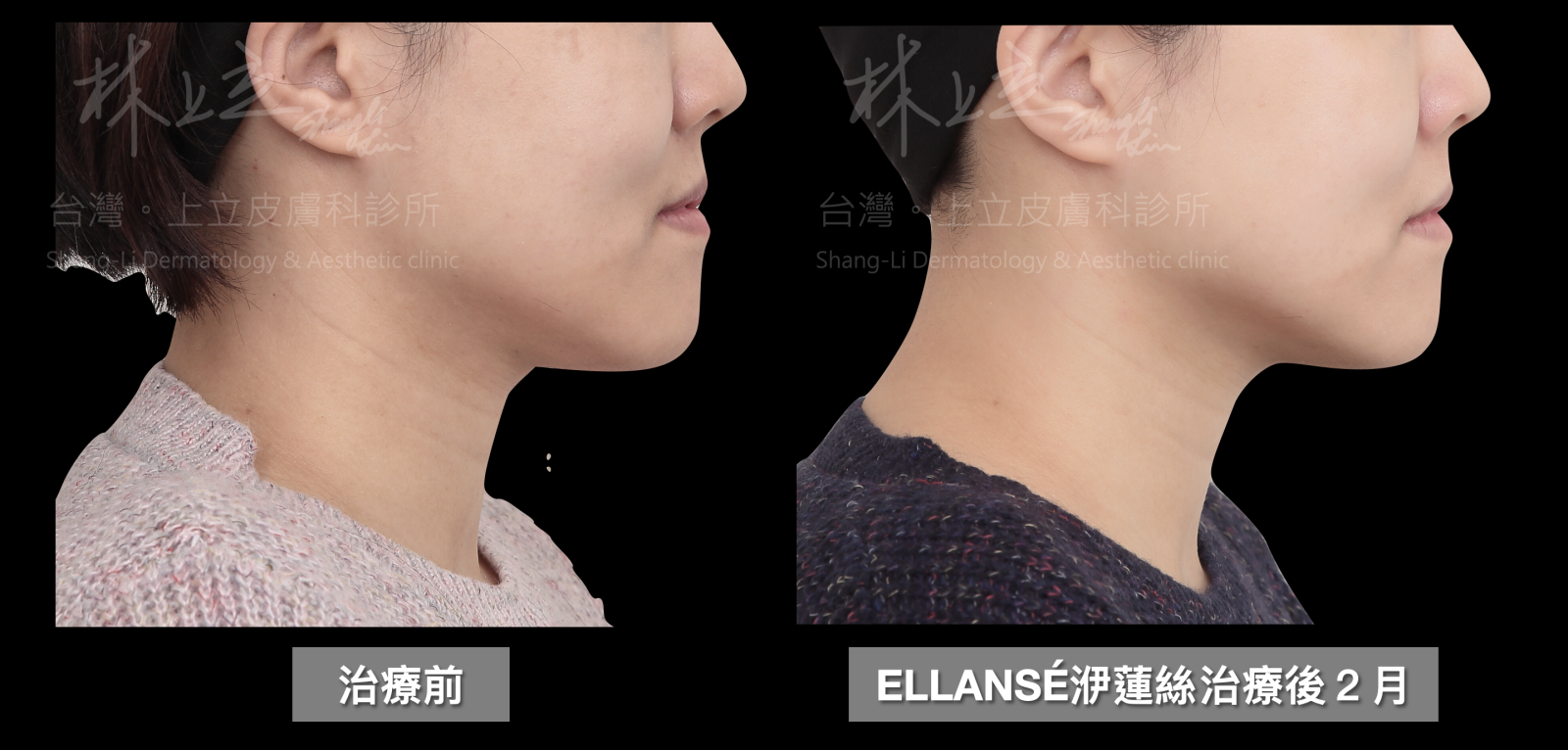 使用ELLANS&Eacute;洢蓮絲治療兩個月後，下顎線條更為俐落，下巴處產生的輕微脂肪堆積也跟著變小