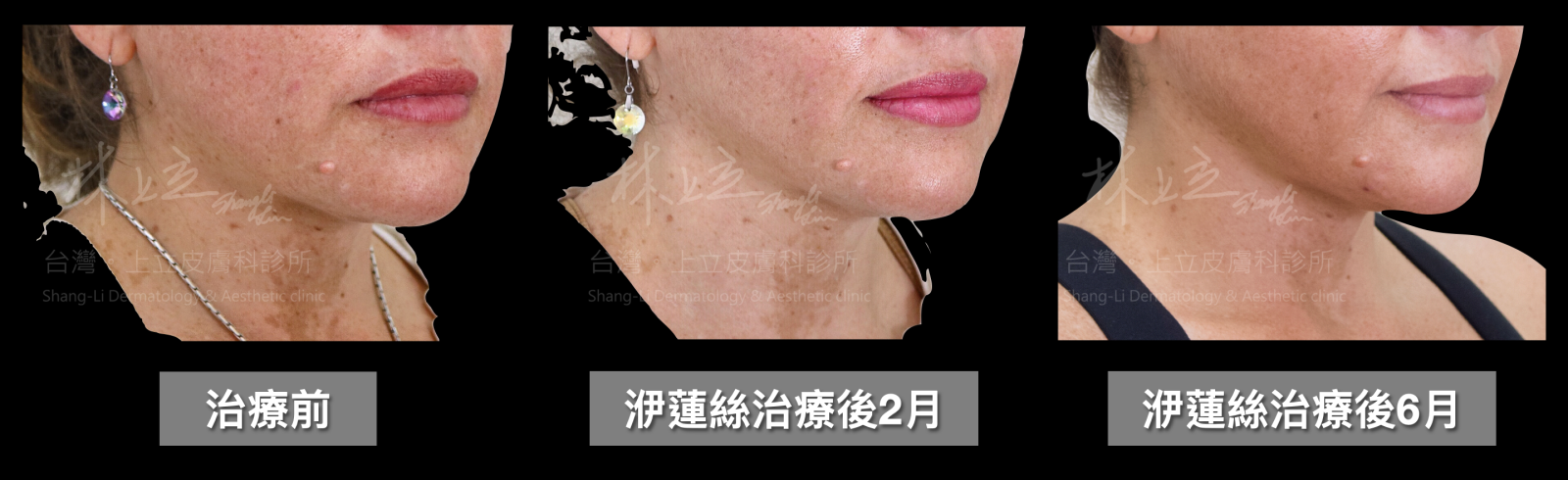 ELLANS&Eacute;洢蓮絲，在治療後6個月下顎輪廓的緊實度和俐落度成效更佳明顯