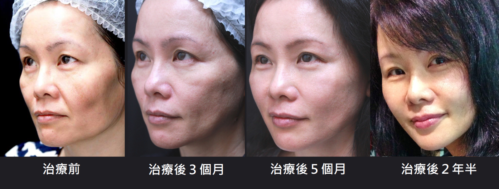 童研針循序漸進的治療效果，為期需要3~6個月