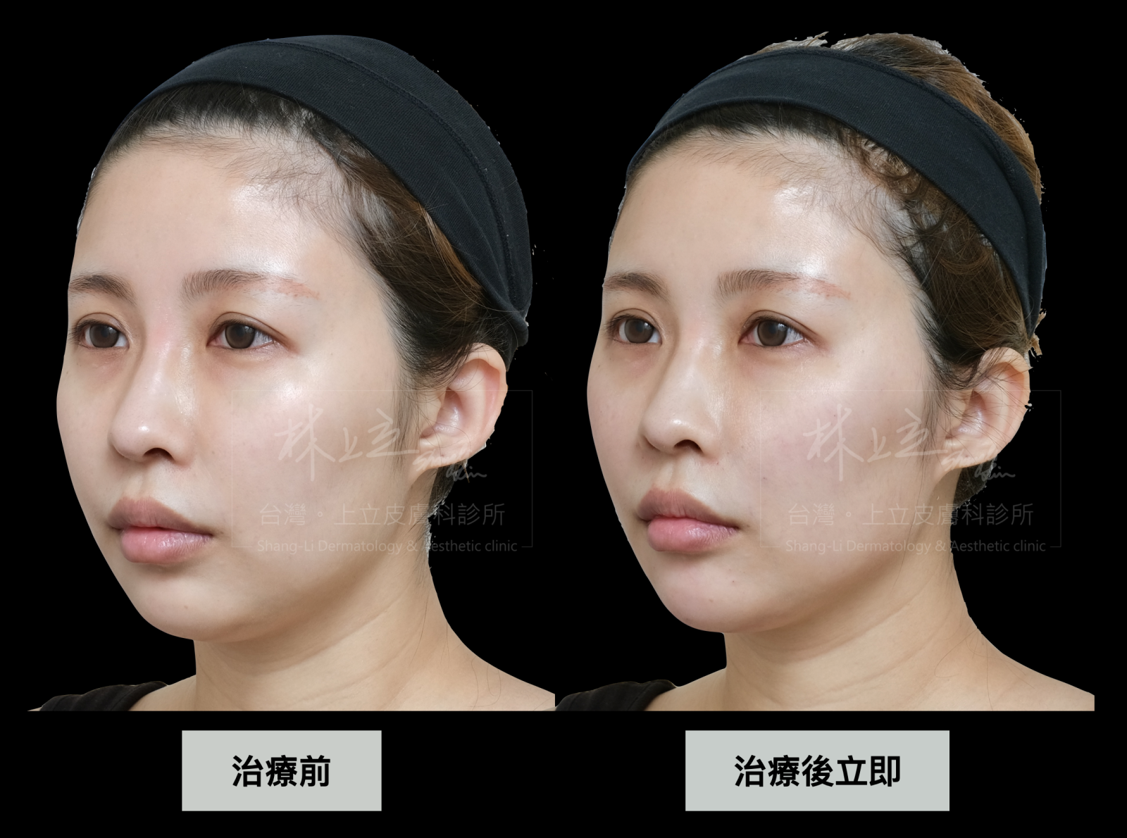 ELLANS&Eacute;洢蓮絲治療後可快速看見治療效果，臉頰上提、臉型變小成果明顯