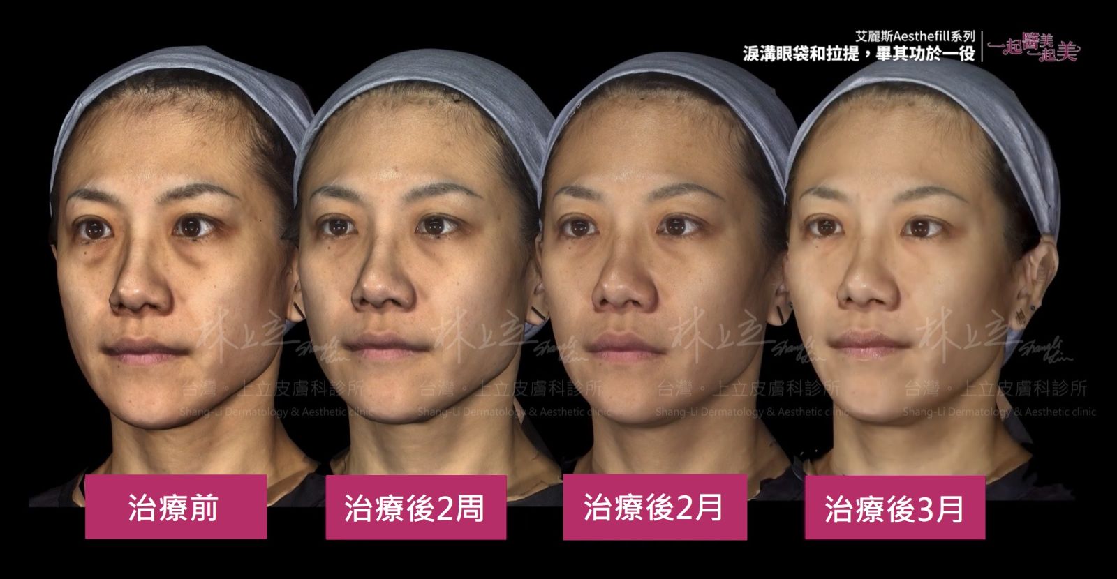 AestheFill艾麗斯治療淚溝，可以快速看見治療效果，2周可以看見明顯效果