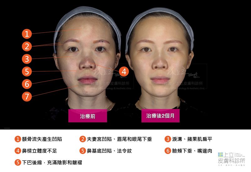 利用AestheFill艾麗斯來改善五官