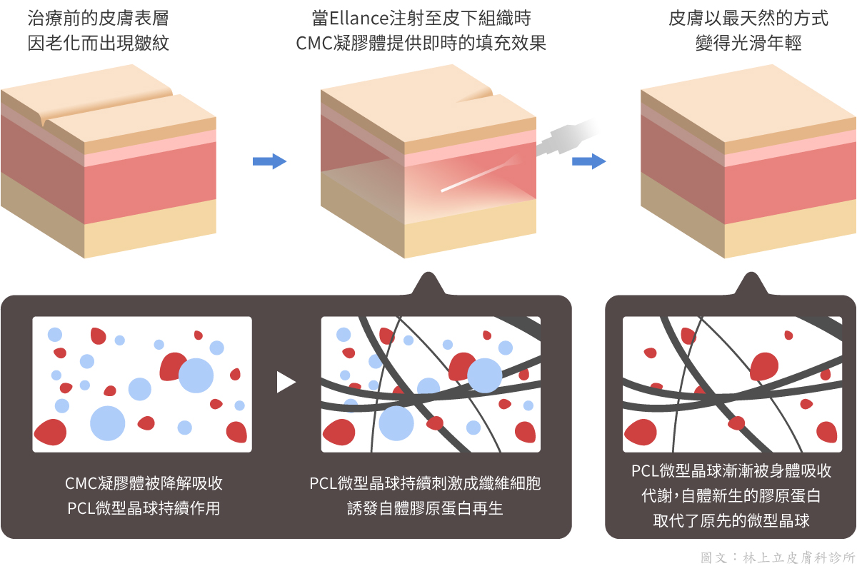 ELLANS&Eacute;洢蓮絲作用原理