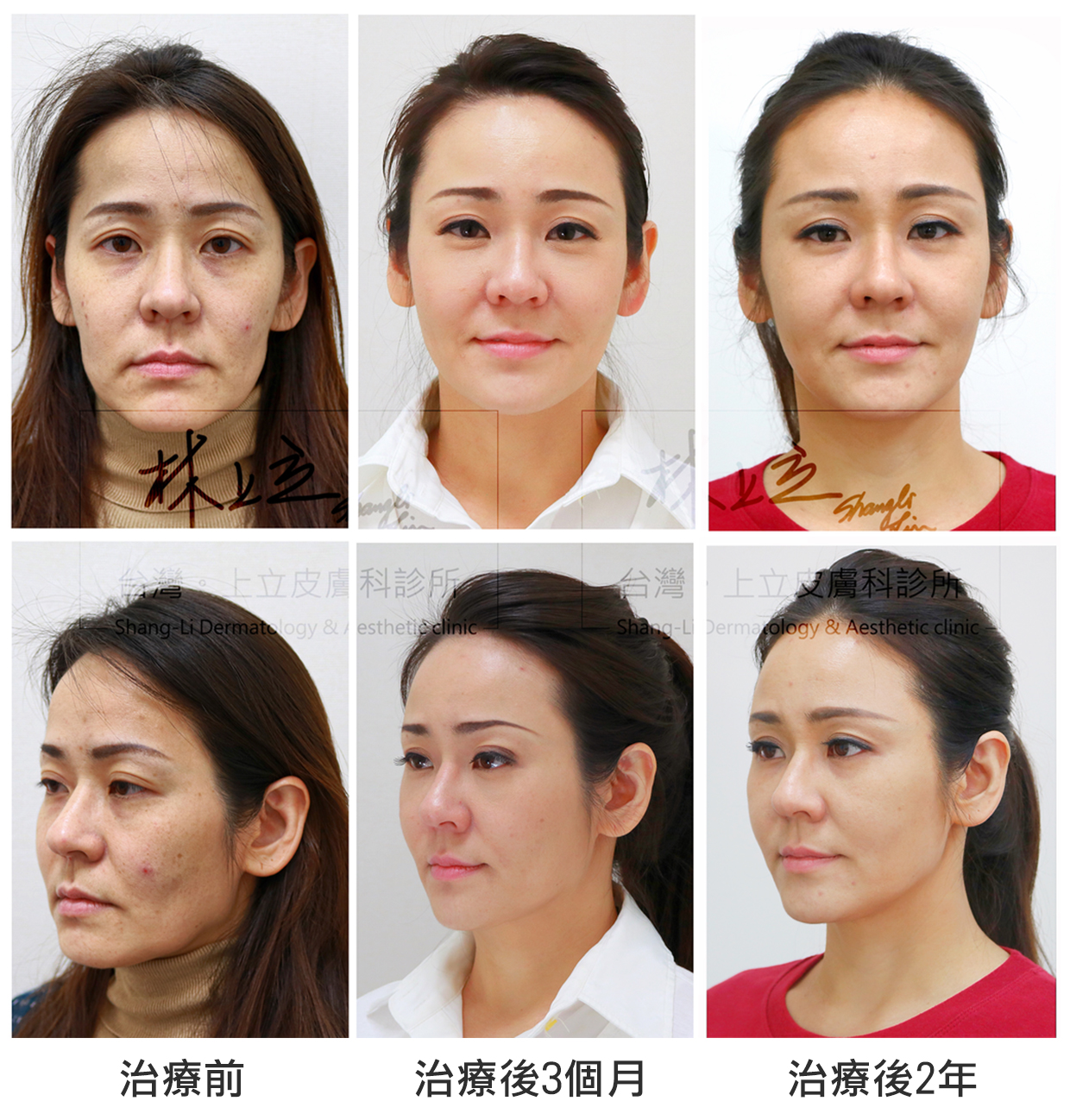 ELLANS&Eacute;洢蓮絲能提供完整支撐，治療後2年，維持著七到八成的效果