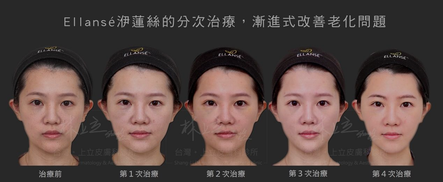 ELLANS&Eacute;洢蓮絲分次治療，漸進式的改善老化問題