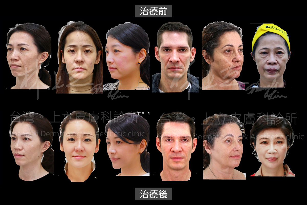 林上立醫師針對個人五官，進行客製化的治療規劃，在變年輕外也可維持各自特色