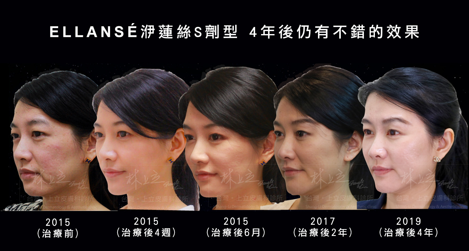 ELLANS&Eacute;洢蓮絲S劑型，治療後四年，維持不錯的效果
