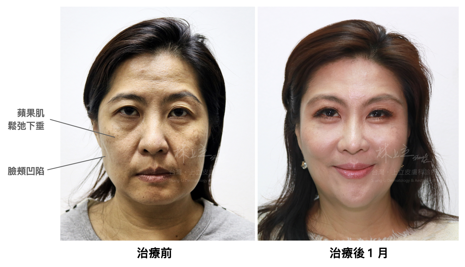 老化流失導致會導致「臉頰內側的」蘋果肌下垂，治療前後對比