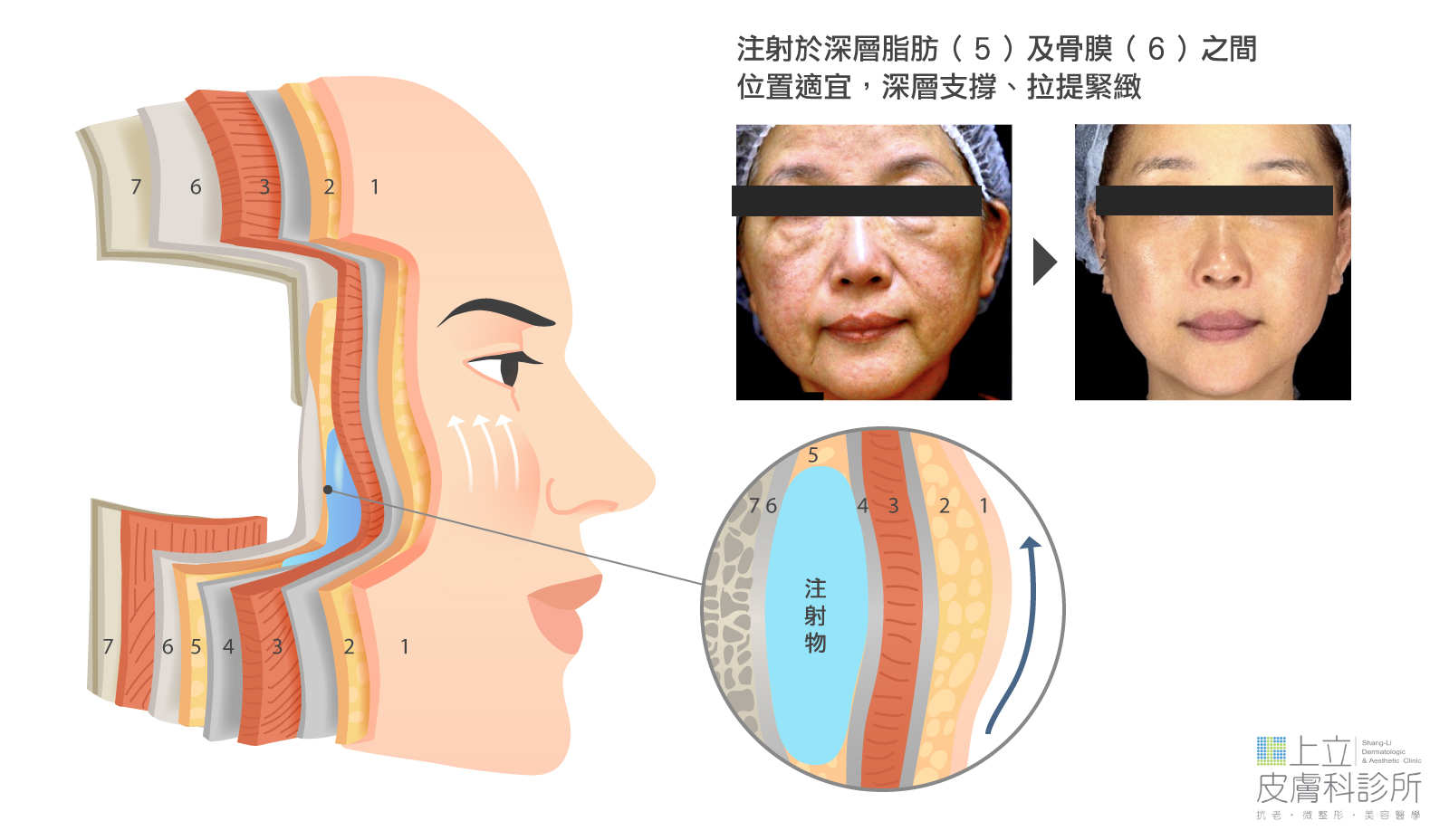 洢蓮絲、艾麗斯等膠原蛋白新生材質正確注射位置