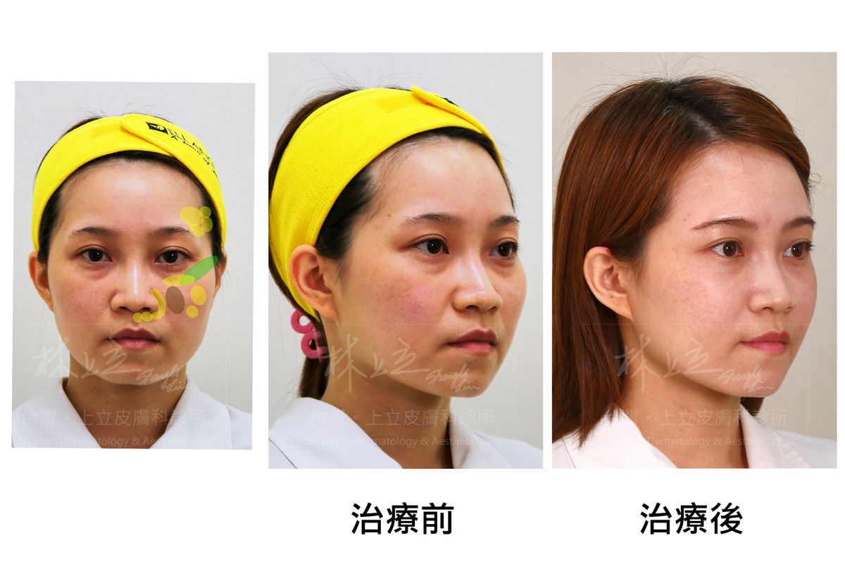 治療前與治療後效果對比