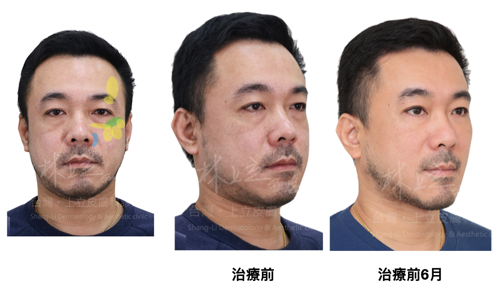 運用洢蓮絲治療前與治療六月後的效果