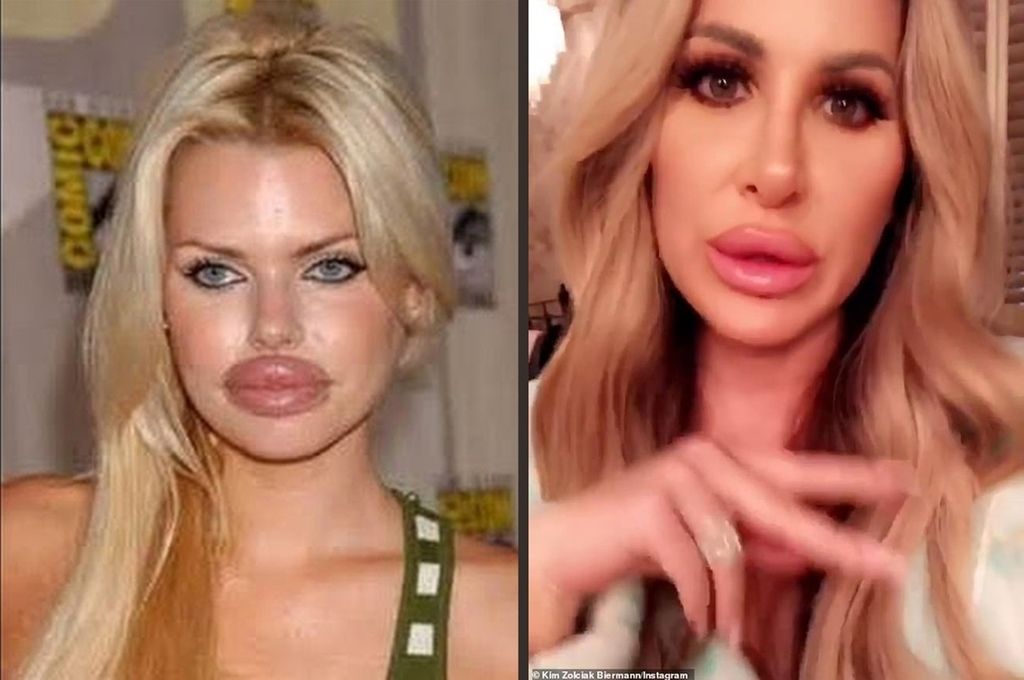 嘴唇變形，形成所謂的「鴨子嘴（duck lips）」