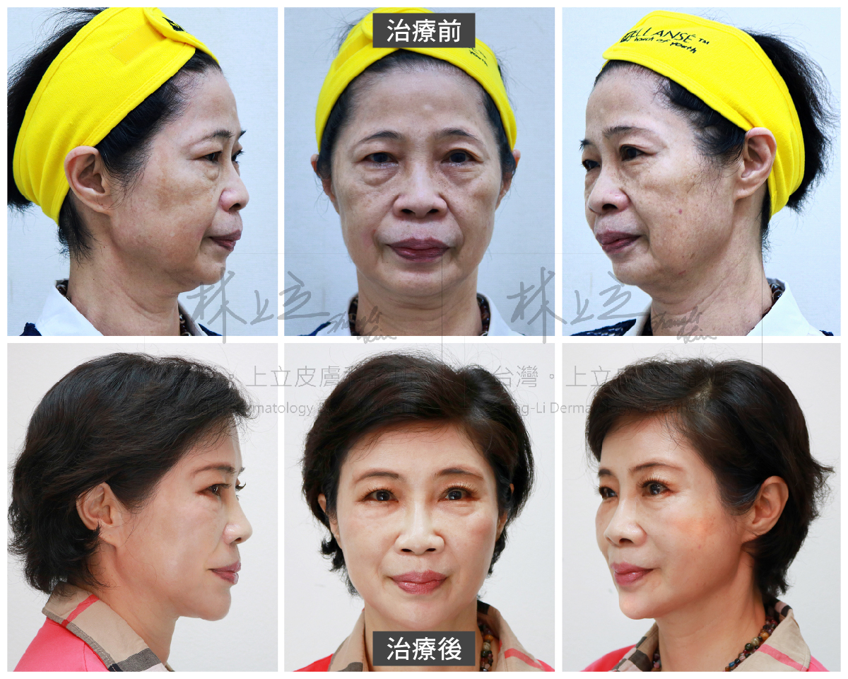 使用洢蓮絲重新建立骨架支撐後，不論是側臉、正面、還是45度角都明顯進步與年輕許多。