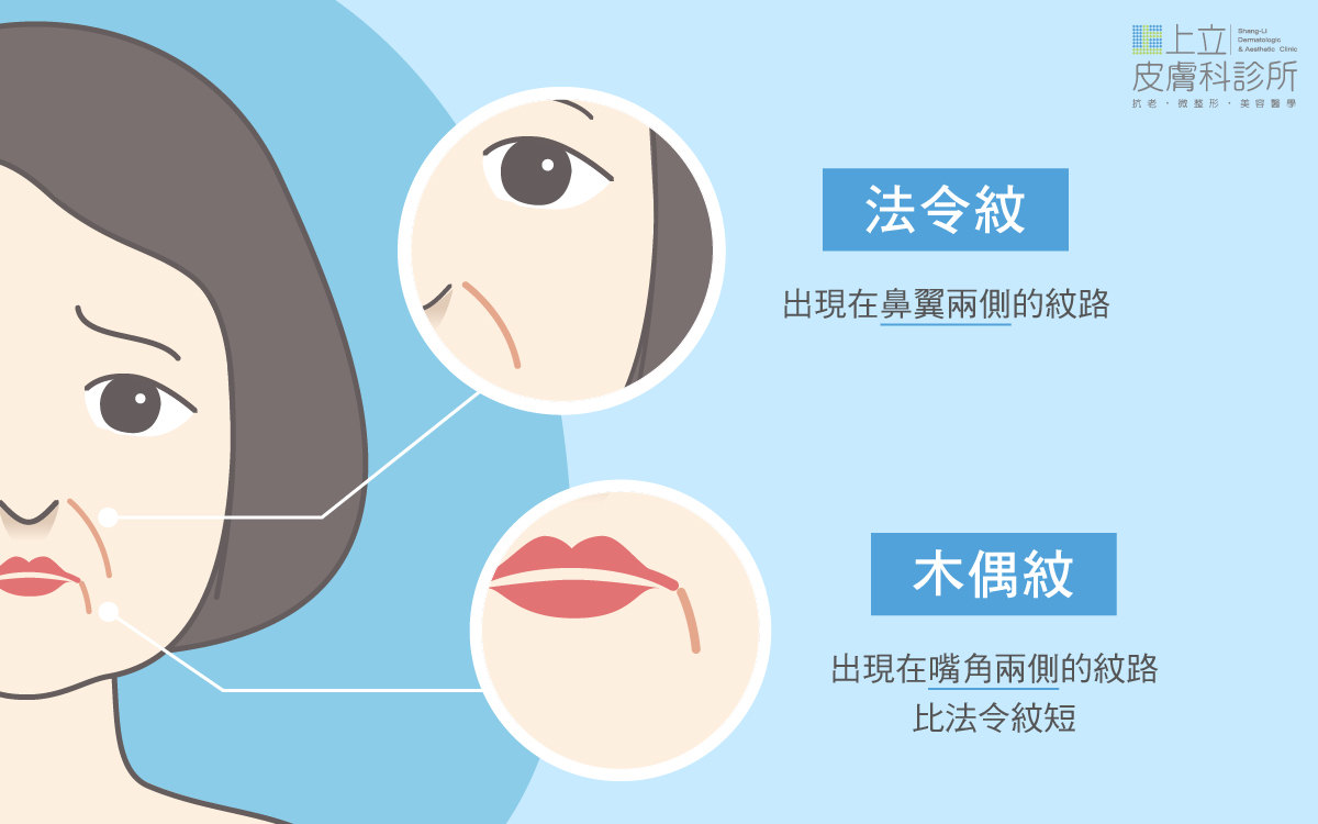 法令紋與木偶雯解說圖