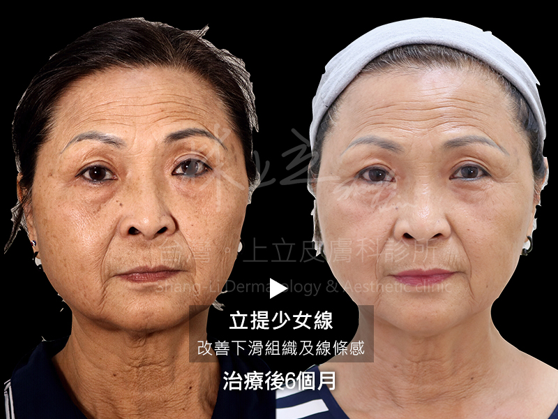 拉提少女線治療六個月後情形