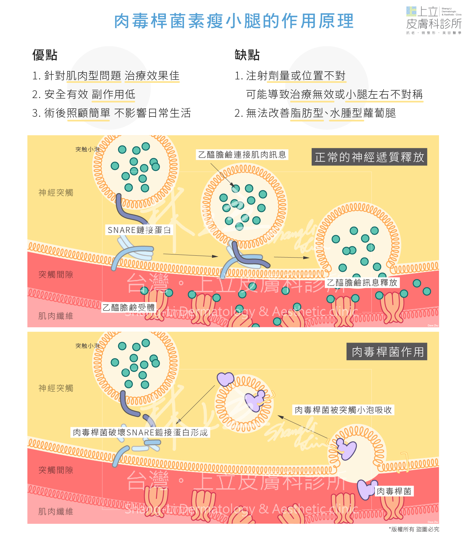 肉毒桿菌瘦小腿的治療原理