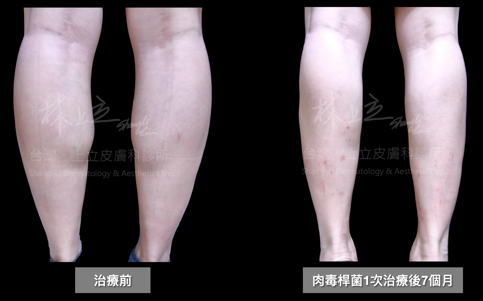 肉毒桿菌素1次治療後的7個月