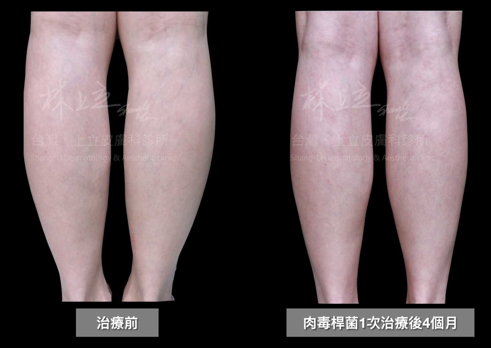 肉毒桿菌1次治療後4個月