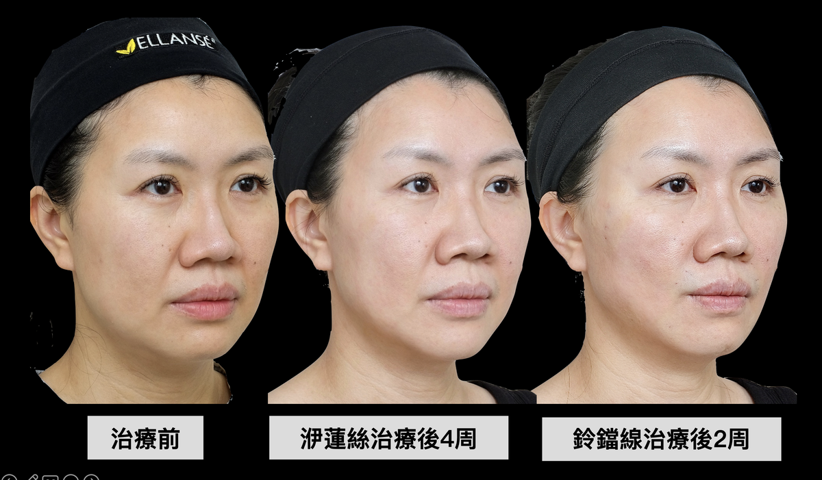 同一個案例從側面45度角觀察，整體效果更加明顯