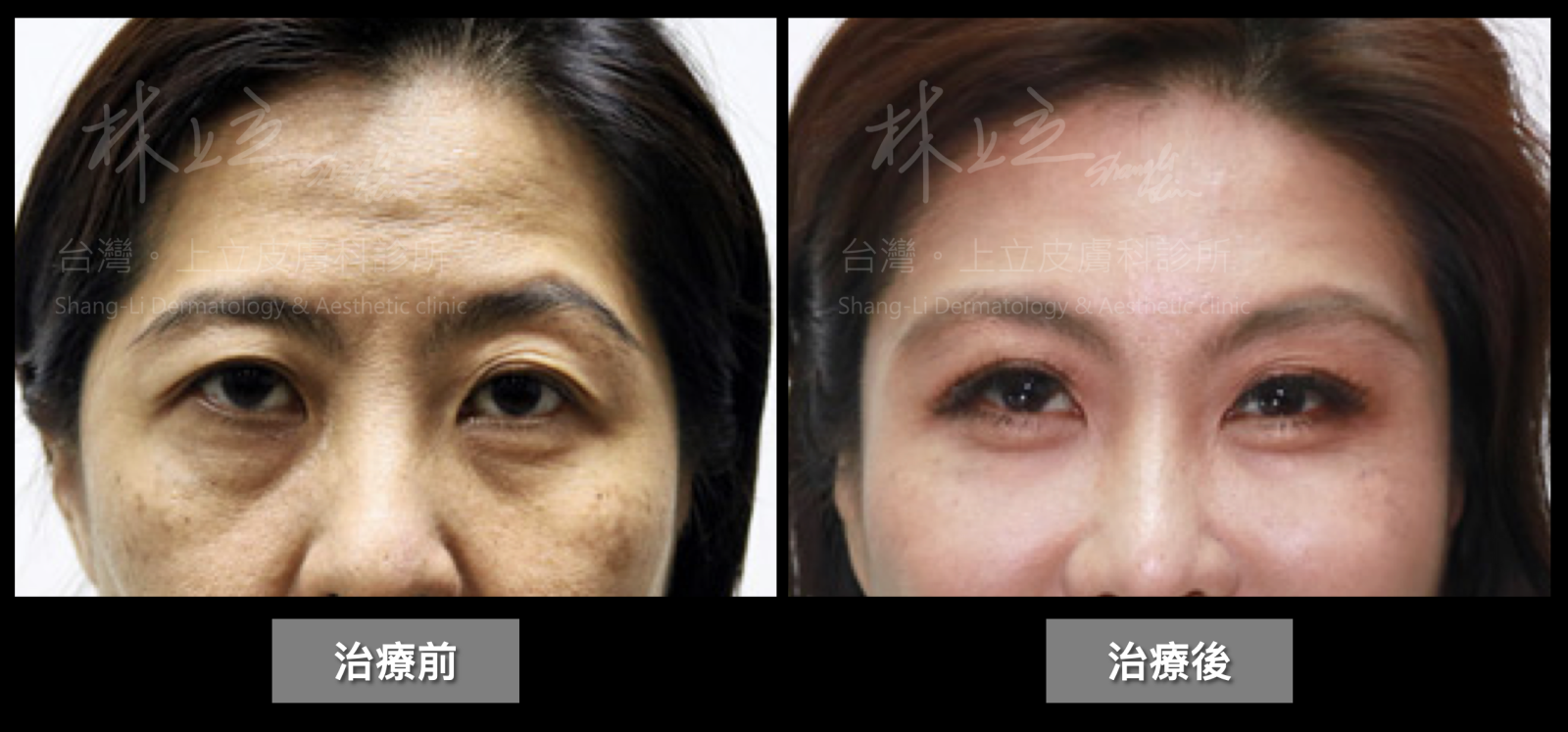 在治療前，嚴重的眼周流失不只造成他的眼神充滿濃濃的疲憊感，顳部和額骨的流失也讓夫妻宮凹陷、眉骨較凸、額頭變窄又充滿陰影，相當老氣，但在重建了整個上臉支撐之後，不只眉眼弧線變柔和了，就臉額頭也恢復平滑飽滿，整個人都年輕許多。