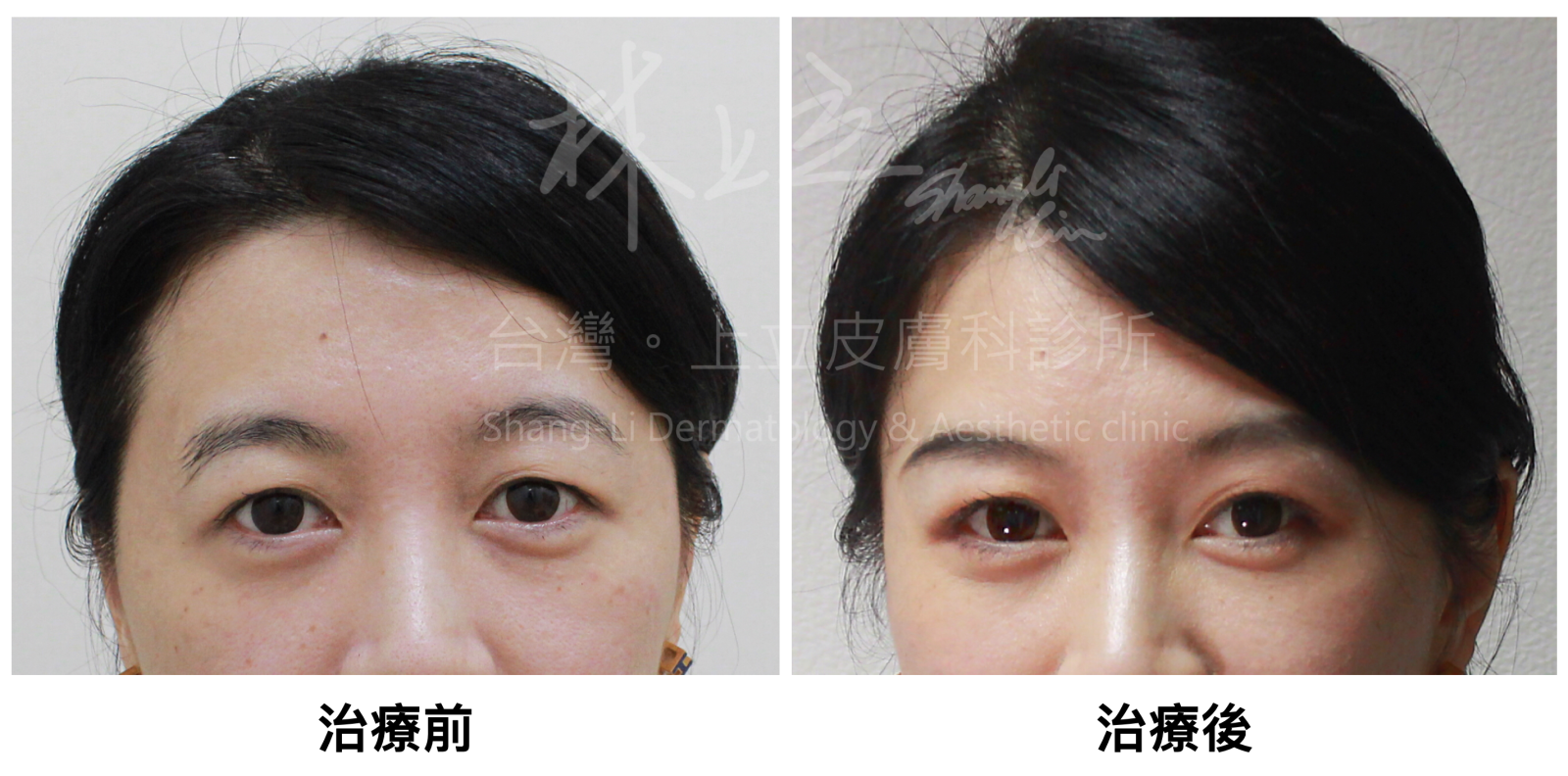 在利用ELLANS&Eacute;洢蓮絲重建良好的骨架支撐後，可以看見他的臉型五官整個都向內集中，變得更加立體，眼神恢復活力，也透出一股女性特有的迷人魅力。