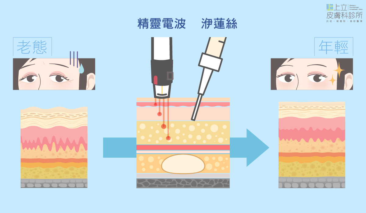 ELLANS&Eacute;洢蓮絲合併眼周，電音波拉提一起治療，重建眼周支撐，同步恢復眼周皮膚的彈性，拉提眉尾