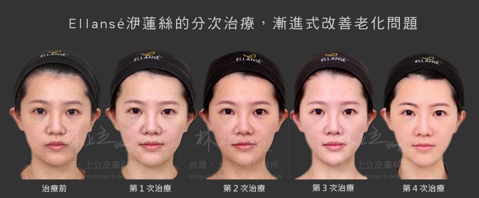配合部分求診者想要「漸進式改善」的治療需求