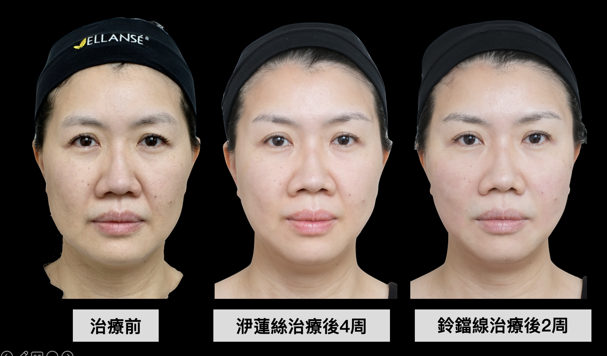 ELLANS&Eacute; 洢蓮絲和Silhouette InstaLift鈴鐺線都是同一家公司研發的產品，都具有很好的治療效果。視個案狀況，林上立醫師也會適時將二者進行合併治療