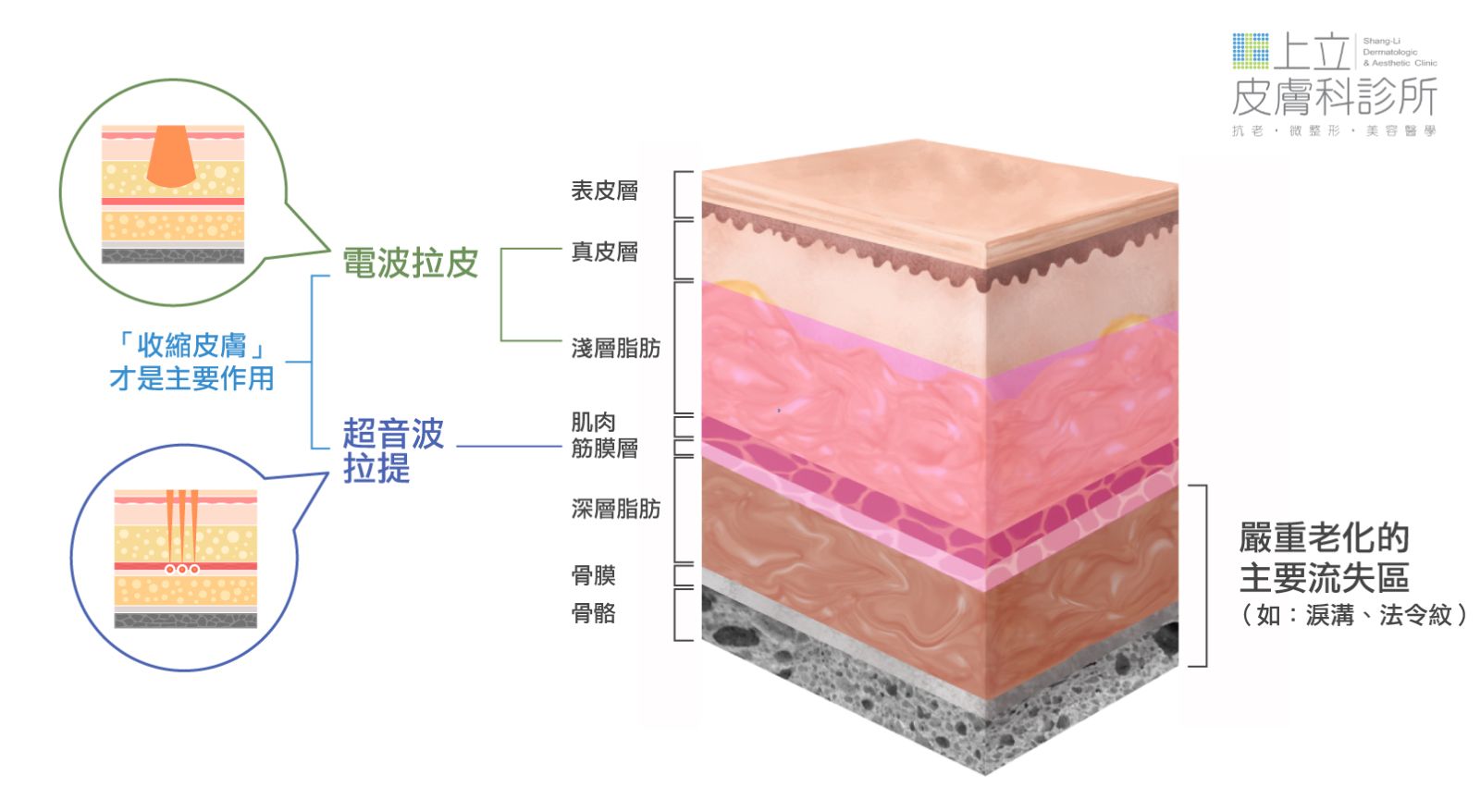 電波拉皮的主要作用是「收縮皮膚」；超音波拉提的主要作用則是「收縮筋膜層」，在視覺上達到緊實膚質、往上拉提的效果