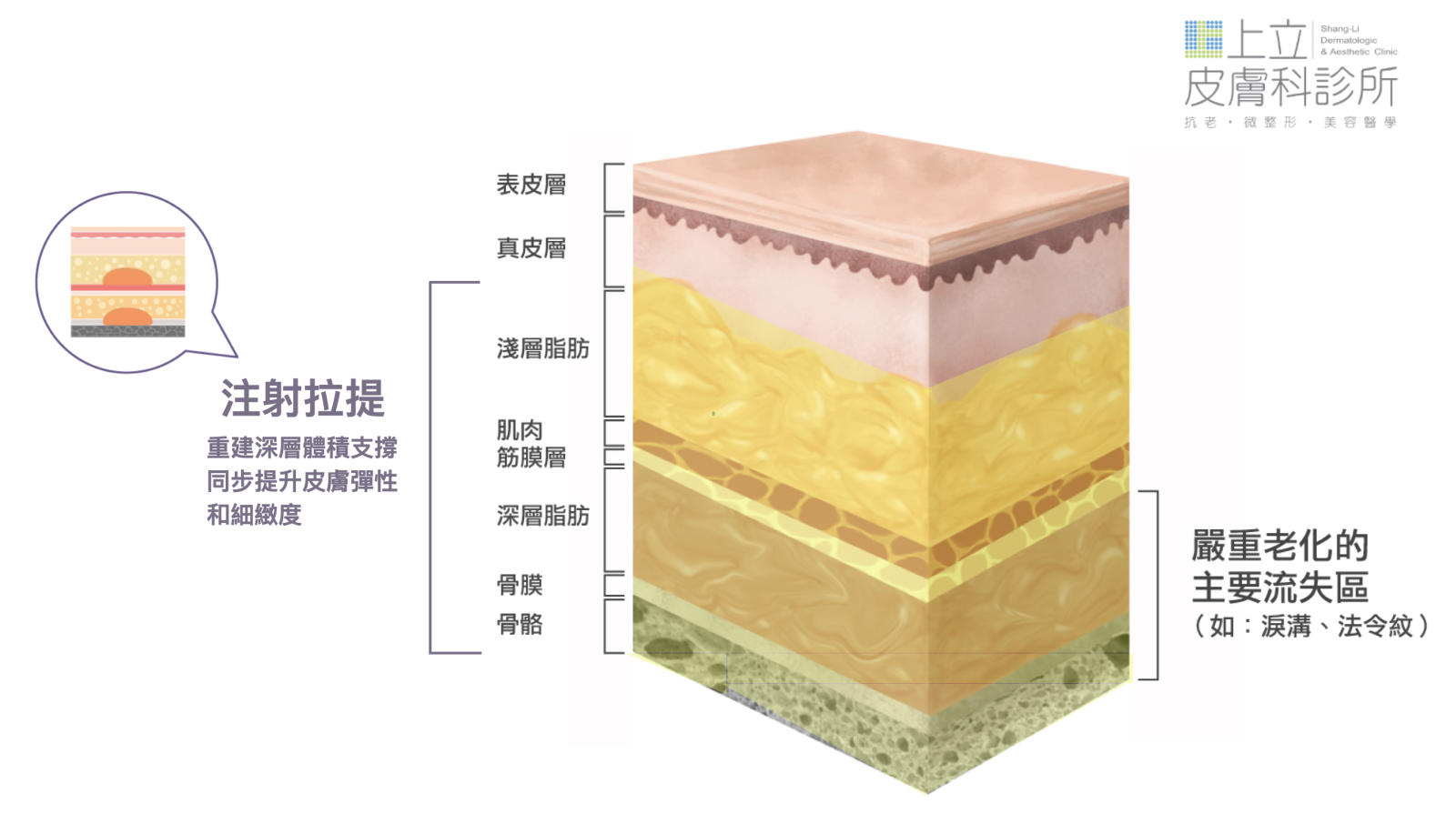 醫師可以針對個人不同膚況問題，量身訂製注射的劑量、深度、點位、施打手法等，不只能消除嘴邊肉，連帶著淚溝、法令紋也會有所改善