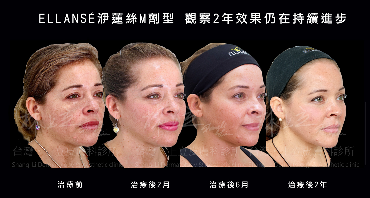 ELLANS&Eacute;洢蓮絲M劑型引進台灣的時間較短，雖尚無治療後4年的案例
