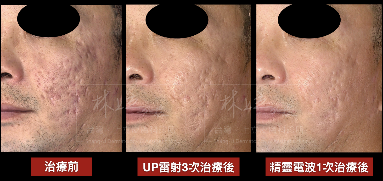林上立醫師使用UP雷射進行3次治療之後，雖整體痘疤已有大幅度改善