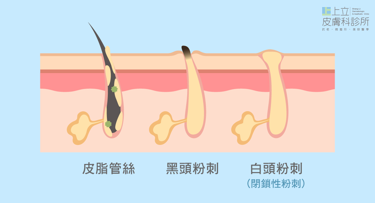 黑頭粉刺、白頭粉刺、皮脂管絲 差異比較