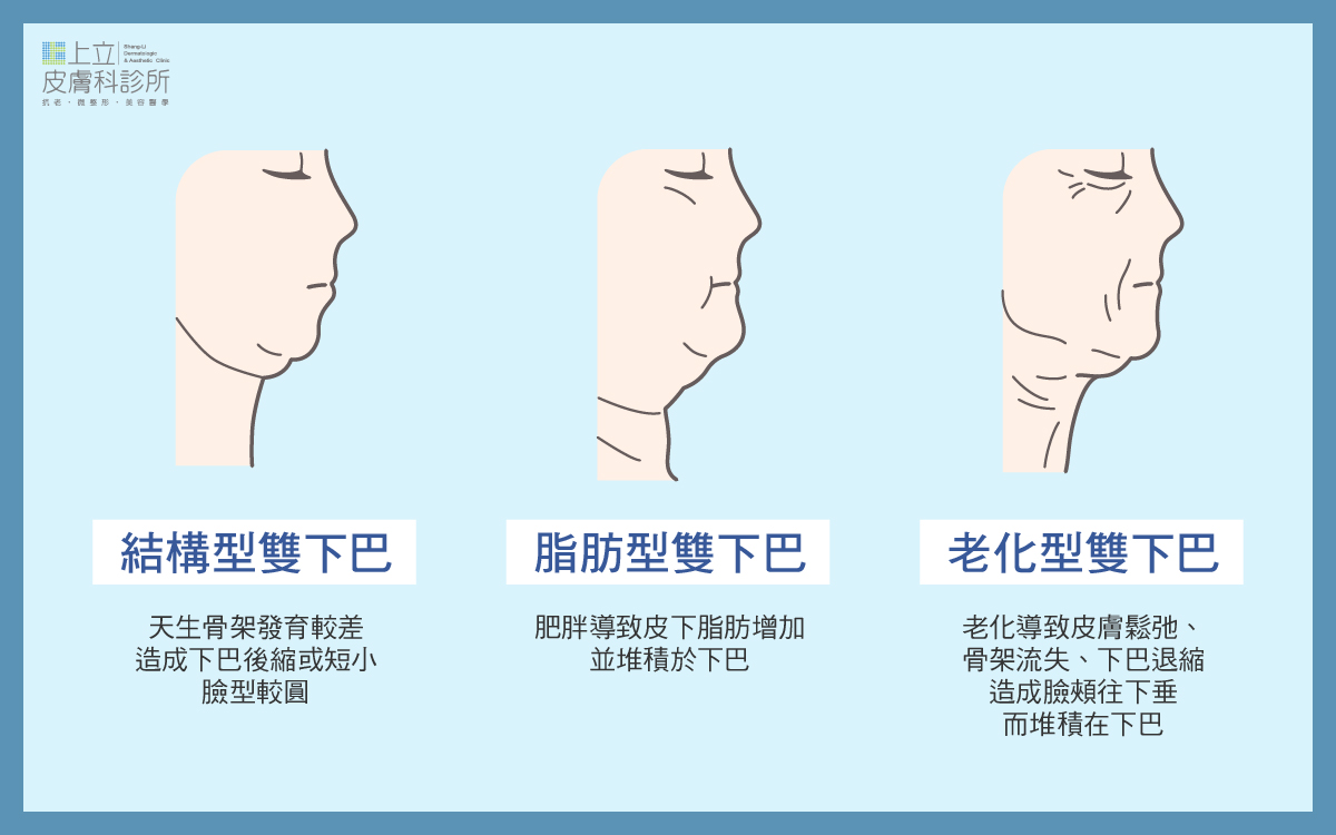 雙下巴類型解說圖