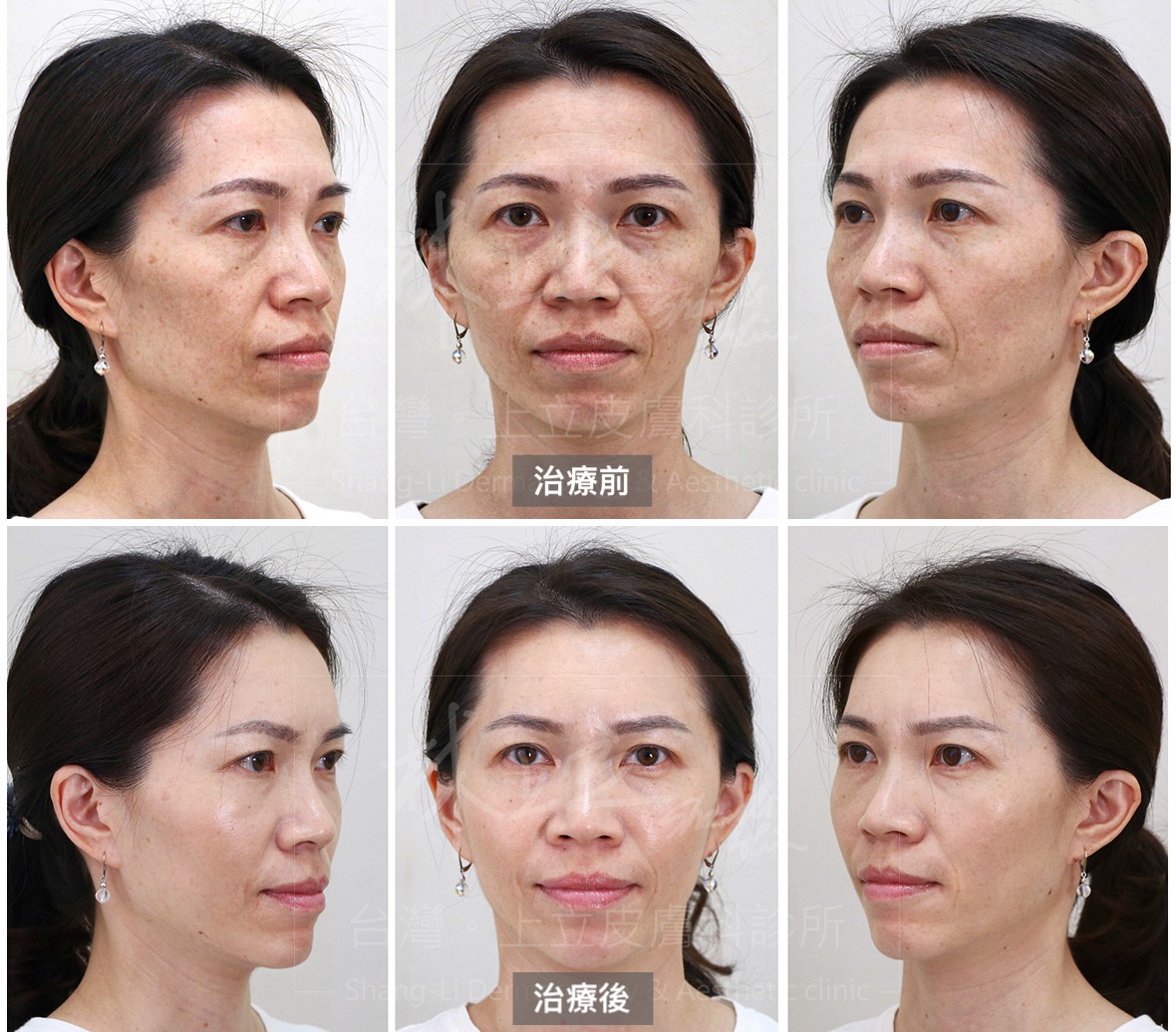 林醫師使用膠原蛋白針劑Ellanse洢蓮絲(少女針)，透過深層注射，打在骨架上以重建骨架支撐，不僅將下垂脂肪歸位，整臉輪廓收緊、提拉起來，法令紋、淚溝、木偶紋等也都明顯改善。