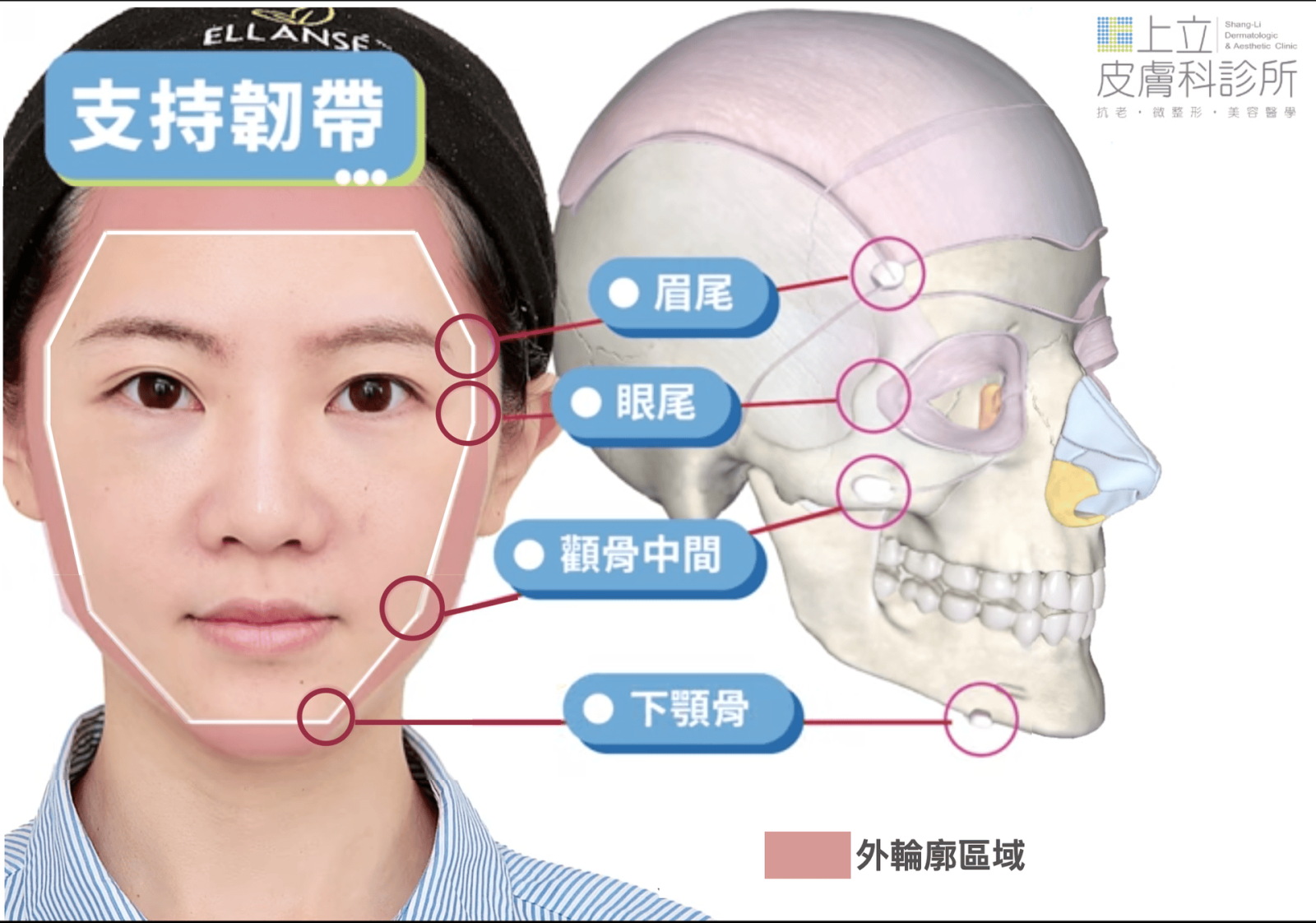 透過將ELLANSE洢蓮絲施打於臉部韌帶位置加強支撐性，有助於全臉組織往上及往後拉提