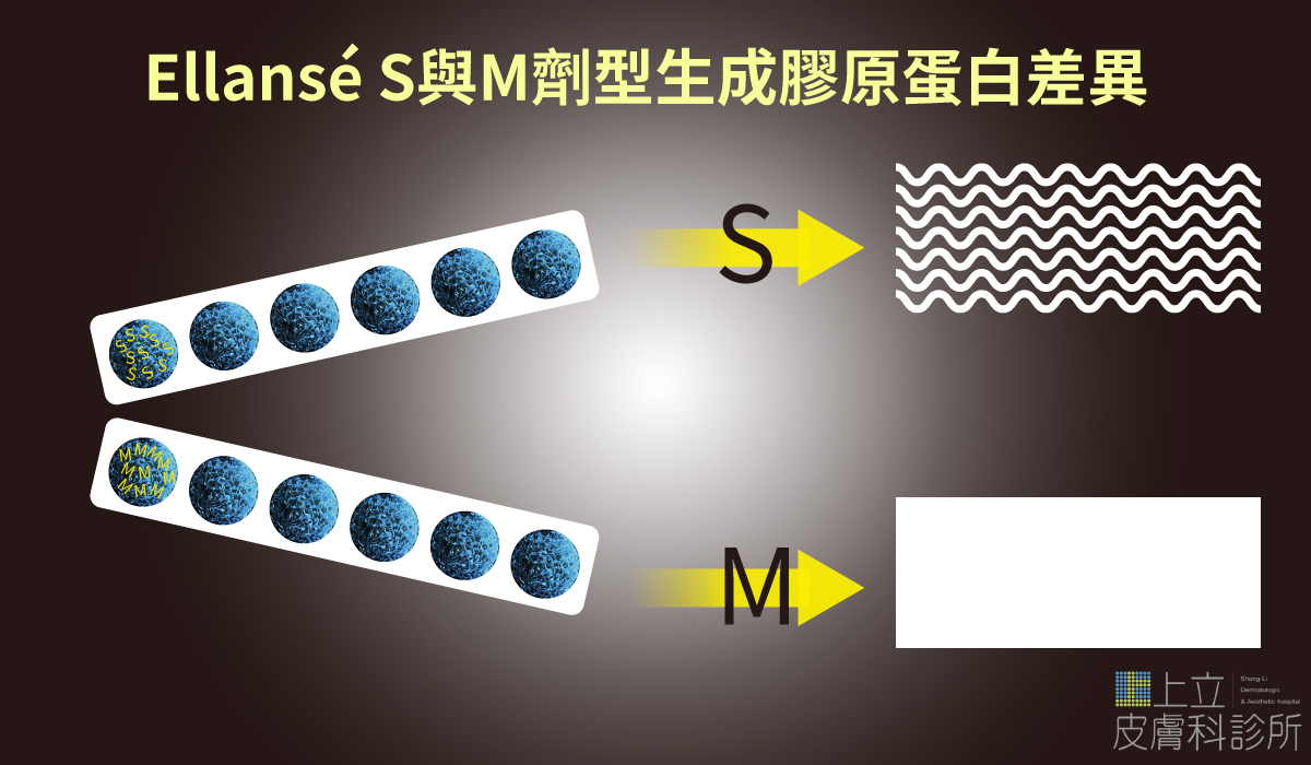 ELLANS&Eacute;洢蓮絲是一種膠原蛋白增生劑