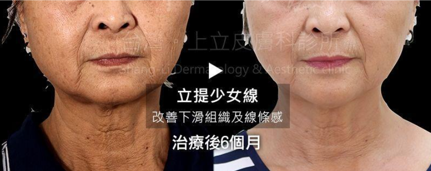 許多人利用埋線拉提來改善木偶紋、嘴邊肉，卻發現效果不如預期的明顯。
