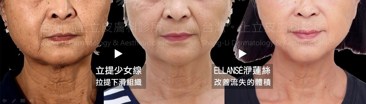 透過ELLANS&Eacute;洢蓮絲重建骨架支撐後，可見木偶紋得到解決