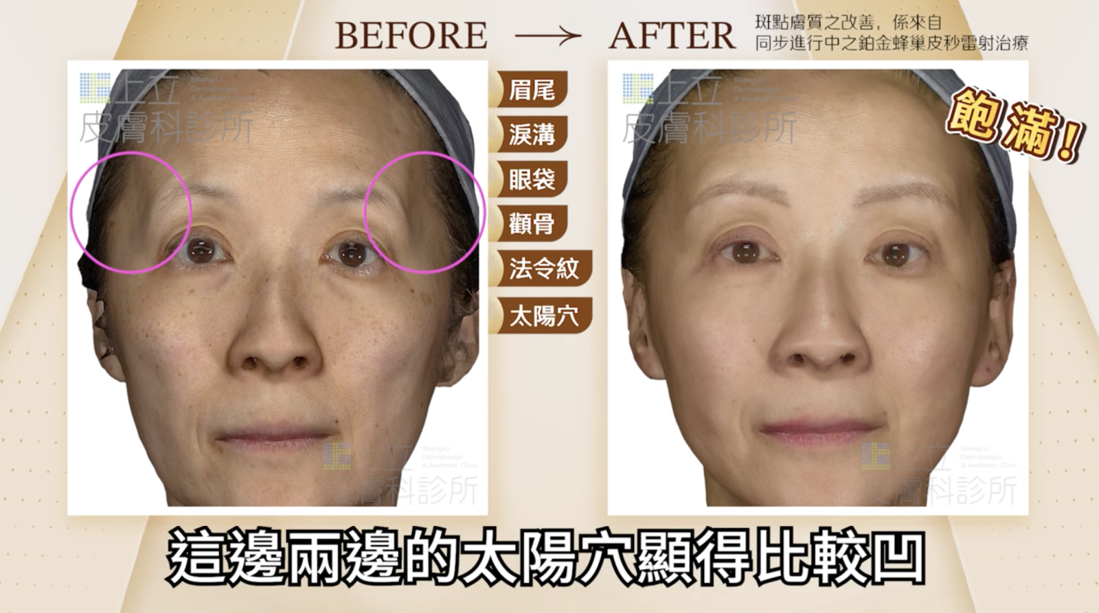 顳部(太陽穴)流失不只會讓影響到眉毛弧度，也會導致額頭變窄、眼尾下垂，甚至讓顴骨感覺更凸