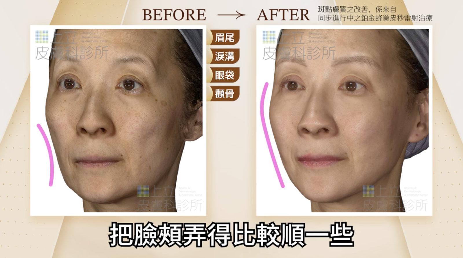 經過妥善的注射治療、重建支撐後，也讓臉頰變得比較飽滿，更有少女感和親和力。