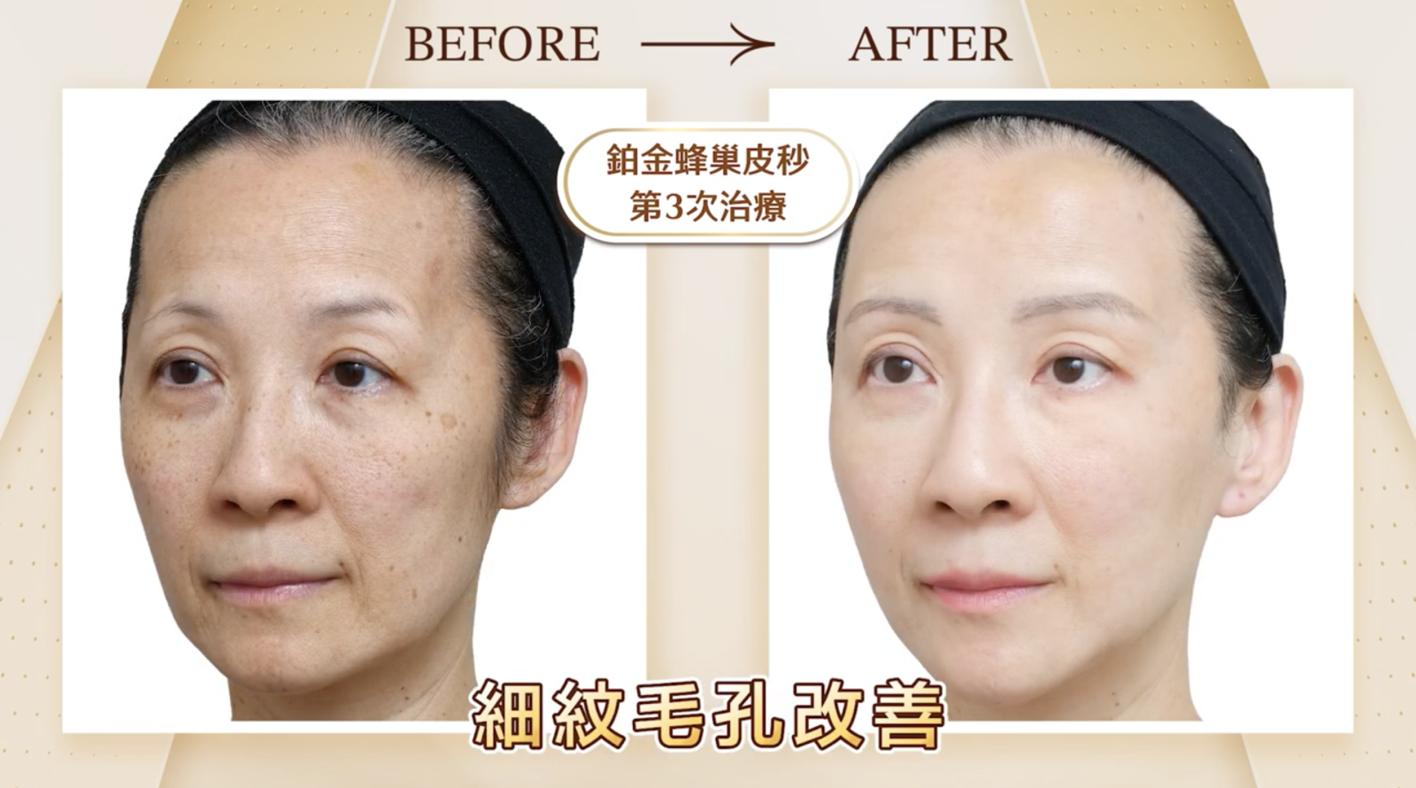 在經過Picosure PRO鉑金蜂巢皮秒的三次治療後，可以明線看見在大面積清除掉皮膚上的斑點之餘，整體膚色的光滑度、明亮度、細緻度都所有提升。