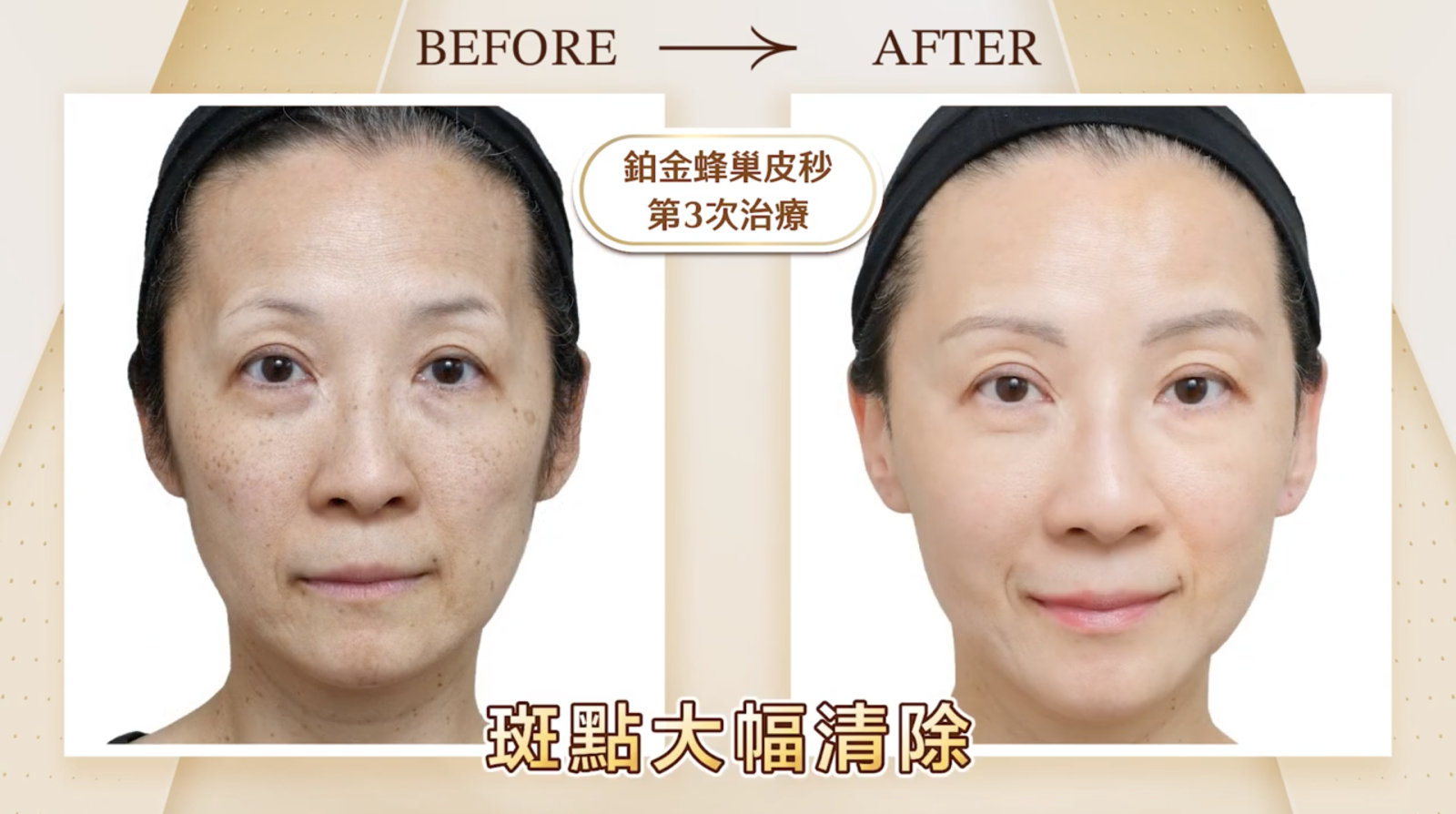 從正面看起來，整個人像是白了一個色階，膚色均勻且非常有光澤感，即使素顏也幾乎看不見細紋、毛孔等瑕疵。