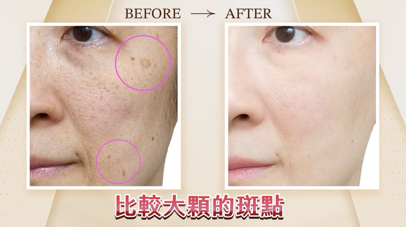 Picosure PRO鉑金蜂巢皮秒所創造的「空泡效應」可以有效刺激真皮層的膠原蛋白新生，幫助那些因老化流失逐漸變大的毛孔恢復緊緻、縮小，讓皮膚看起來更為光滑細緻。